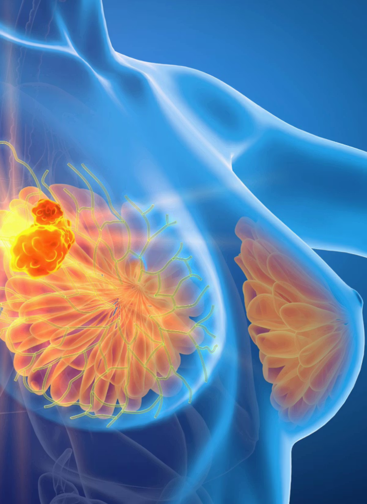 FDA Approves Palbociclib for Maintenance Treatment in HR+/HER2+ Breast Cancer