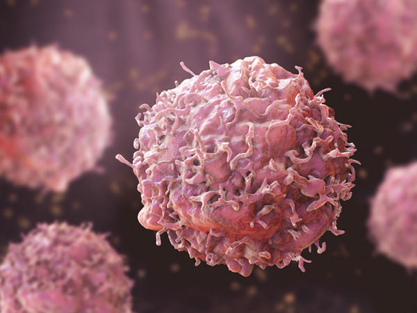 Colorectal Cancer