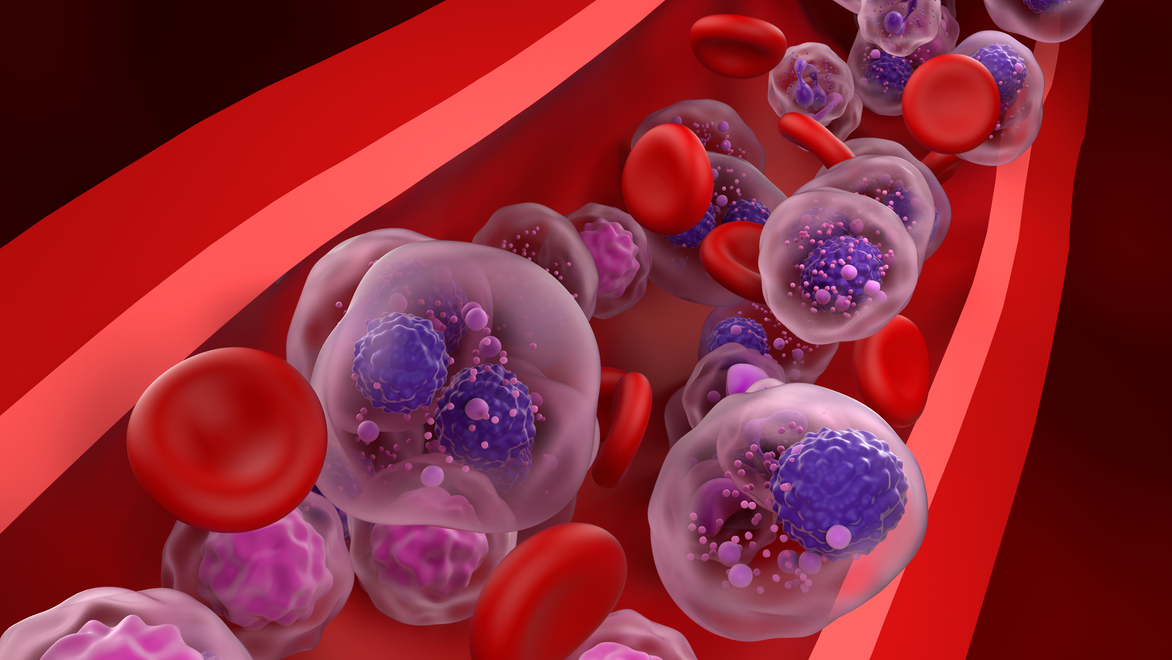 Multiple Myeloma